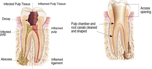 Root Canal - Tauranga Endodonist