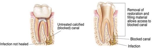 Endodontist Retreatment - Bay Endodontists