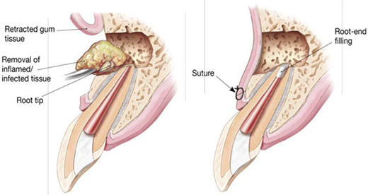 Apical Surgery - Bay Endodontists